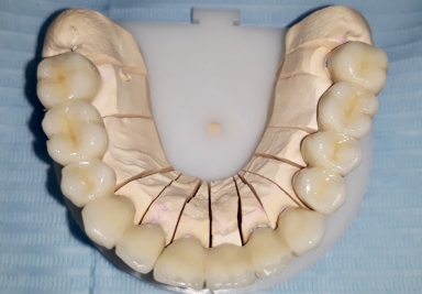 Complete oral rehabilitation
