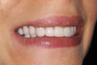 Ceramic crowns and veneers, dental implants