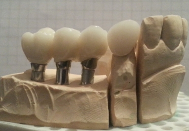 Dental implants, porcelain crowns