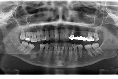 implant dentar