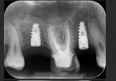 Dental implants premolar