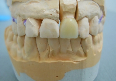 Full ceramic crown on central incisor