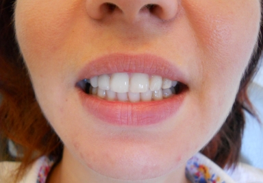 Full ceramic crown on upper lateral incisor