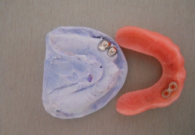 Dental prosthesis