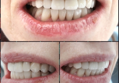 Full mouth restorations