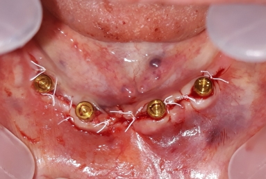 prosthetic bridges dental implant