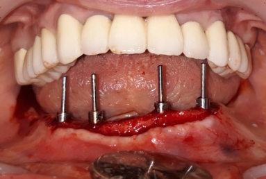 prosthetic bridges dental implant