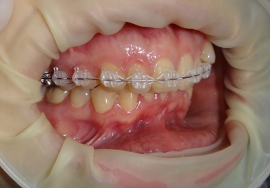 Sapphire orthodontic device