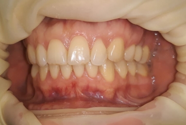 Orthodontic treatment