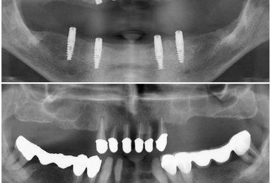 dental implant Mobile Prosthesis