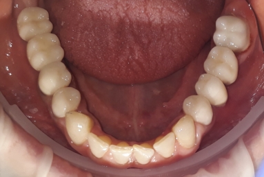 surgical treatment dental implants, ceramic crowns
