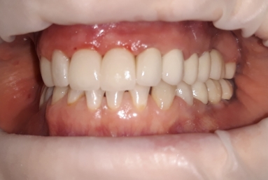 surgical treatment dental implants, ceramic crowns