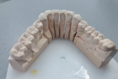 ceramic veneers on the lower frontal teeth