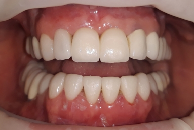 ceramic veneers on the lower frontal teeth
