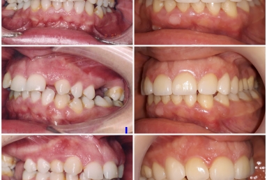 Lateral incisors anodontia - dental implants , sinsus lift