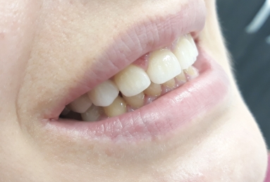 Lateral incisors anodontia - dental implants , sinsus lift