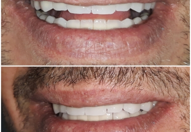 Full mouth rehabilitation with dental implants