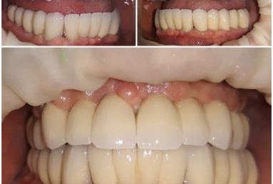 Full mouth rehabilitation with dental implants and fixed ceramic crowns