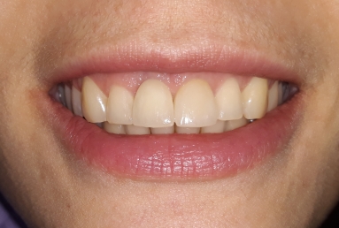 Megagen Anyridge dental implant