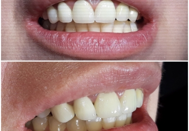 Zirconium crowns on teeth and implants