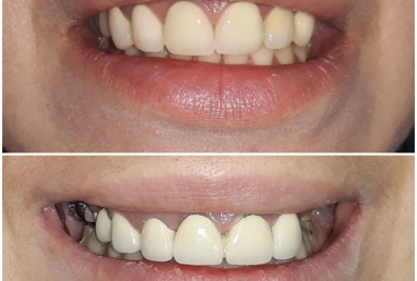 Zirconium crowns on teeth and implants