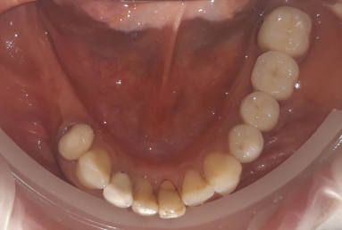 Ceramic crowns and veneers, dental implants